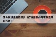 法令纹填充前后照片（打玻尿酸的危害及后期副作用）