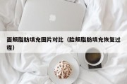 面颊脂肪填充图片对比（脸颊脂肪填充恢复过程）