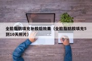 全脸脂肪填充补胶后效果（全脸脂肪胶填充5到10天照片）